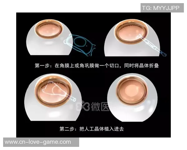 提升足球运动表现的近视眼镜选择与使用指南